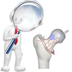 激素诱发股骨头坏死