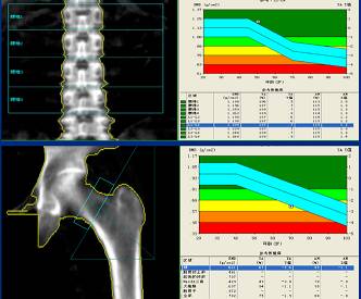 山东超声骨密度仪厂家医学常识中影响骨密度测量的因素有哪些？