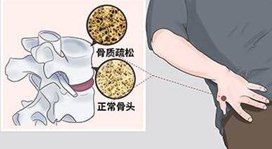 超声骨密度检测仪品牌检测骨密度简单易行的方法