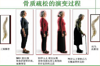 骨密度仪生产厂家关于得了骨质疏松如何增加骨密度提高骨强度